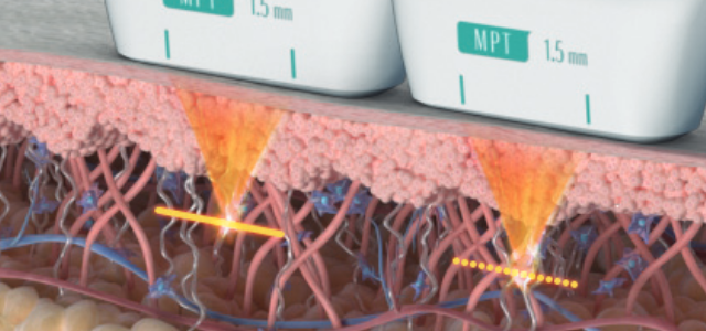 Ultraformer MPT linear-cartridge Micro Pulse and Normal mode diagram